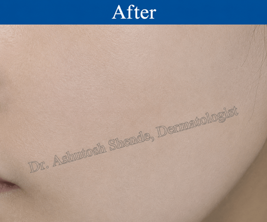  Acne with Inflammation after After