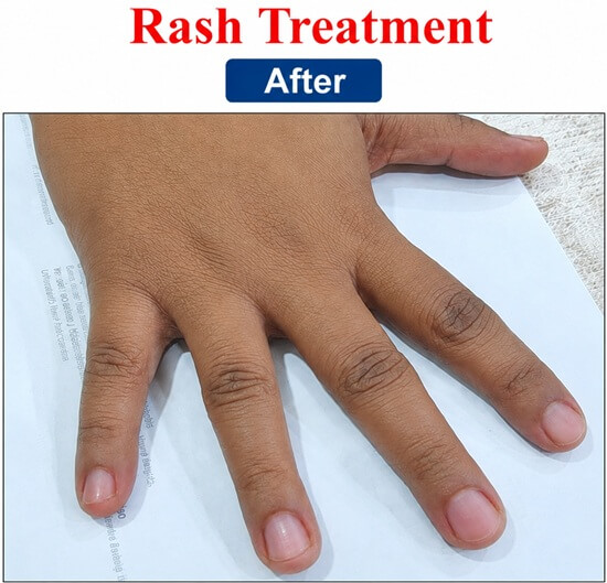  Allergic Hand Rash Treatment After