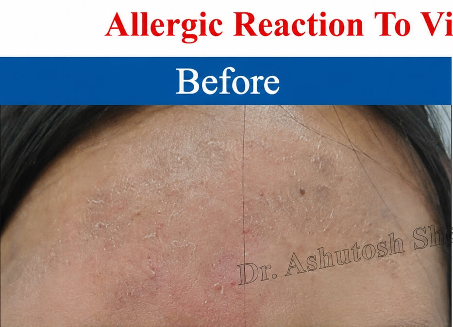 allergic reaction before