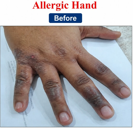  Allergic Hand Rash Treatment before