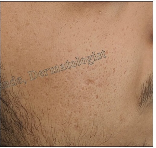  Cystic Acne After