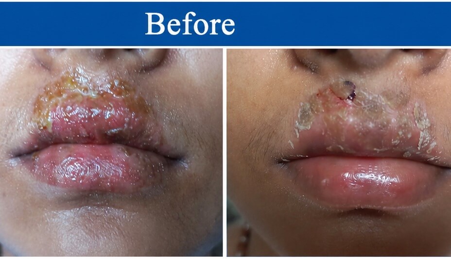 Lip Treatment Before